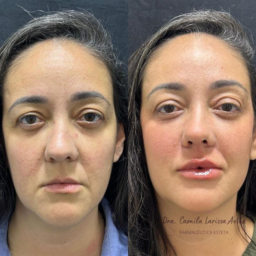 Resultado de harmonização facial
