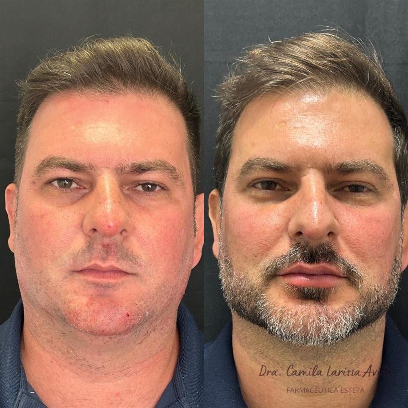 Resultado de harmonização facial