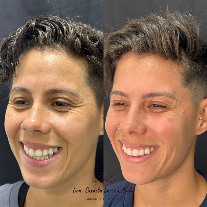Resultado de harmonização facial