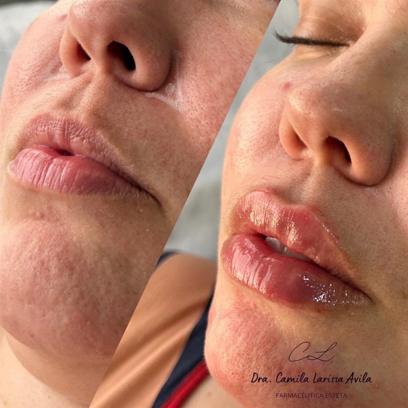 Resultado de preenchimento labial
